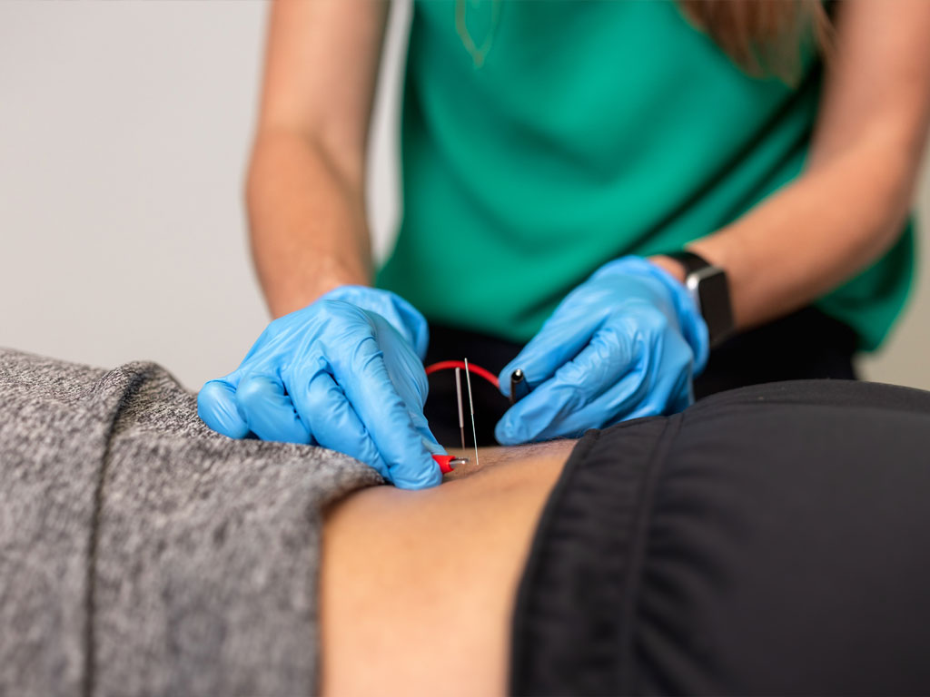 Dry Needling | Livwell Physical Therapy and Wellness